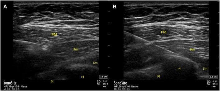 Two side-by-side ultrasound (US) images (A and B) demonstrate the regional anatomy and procedural technique for Pectoralis (PECS) nerve blocks. A high-frequency linear probe reveals the layered musculature of the anterior chest wall. The pectoralis major (PM) and pectoralis minor (Pm) muscles appear as superficial hypoechoic layers with characteristic striated fiber patterns separated by hyperechoic fascial planes. Deep to these lies the serratus anterior muscle (Sm). In the inferior portion of the frame, the fourth rib (r4) is identified as a bright, curvilinear hyperechoic interface with distinct posterior acoustic shadowing. The pleura (Pl) is visible as a smooth, hyperechoic horizontal line located deep to the intercostal space. Image A illustrates the target site for a PECS I block, where local anesthetic is delivered into the fascial plane between the pectoralis major and minor. Image B demonstrates a PECS II block, showing an in-plane needle approach targeting the fascial plane between the pectoralis minor and serratus anterior muscles. This diagnostic ultrasound provides critical guidance for regional anesthesia by identifying vascular and pleural landmarks to prevent complications such as pneumothorax.