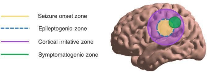 This medical illustration presents an anatomical diagram of the human brain, specifically focusing on the spatial localization and overlap of different zones involved in epilepsy. The diagram uses a lateral view of the cerebral cortex with four distinct color-coded regions to demonstrate the conceptual schema of epileptic phenomena. The Seizure Onset Zone (SOZ) is depicted as a central yellow solid circle, representing the area where clinical seizures originate. Encapsulating the SOZ is the Epileptogenic Zone (EZ), marked by a blue dashed circular line, defined as the minimum area of brain tissue necessary for resection to achieve seizure freedom. A larger purple circle represents the Cortical Irritative Zone, indicating the region generating interictal spikes, which typically encompasses both the EZ and SOZ. Finally, the Symptomatogenic Zone is shown as a green solid circle on the periphery; it partially overlaps with the other zones, representing the cortical area that, when activated, produces the initial clinical symptoms. This graphic illustrates the clinical challenge of surgical localization, where these theoretical zones may not perfectly align.