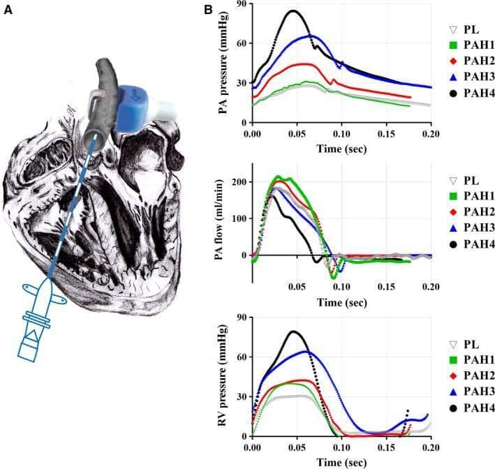 This composite educational graphic details in vivo hemodynamic measurement techniques and results in the context of pulmonary arterial hypertension (PAH). Panel A presents an anatomical diagram of a heart, illustrating the positioning of a dual pressure sensor catheter inserted through the right ventricle into the main pulmonary artery (MPA), complemented by an ultrasonic flow probe wrapped around the MPA. Panel B displays three time-series hemodynamic graphs (0.0 to 0.20 seconds) comparing a placebo (PL) control group with four progressive stages of PAH (PAH1-PAH4). The top graph shows MPA blood pressure (mmHg), demonstrating a progressive increase in peak systolic pressure and steeper systolic slopes as disease severity increases. The middle graph depicts MPA flow (ml/min), showing relatively stable peak flow across stages but altered waveform morphology. The bottom graph shows right ventricular (RV) pressure (mmHg), highlighting a significant rise in RV systolic pressure (RVSP) from ~30 mmHg in PL/PAH1 to nearly 80 mmHg in stage PAH4, indicating increased ventricular afterload and disease progression.