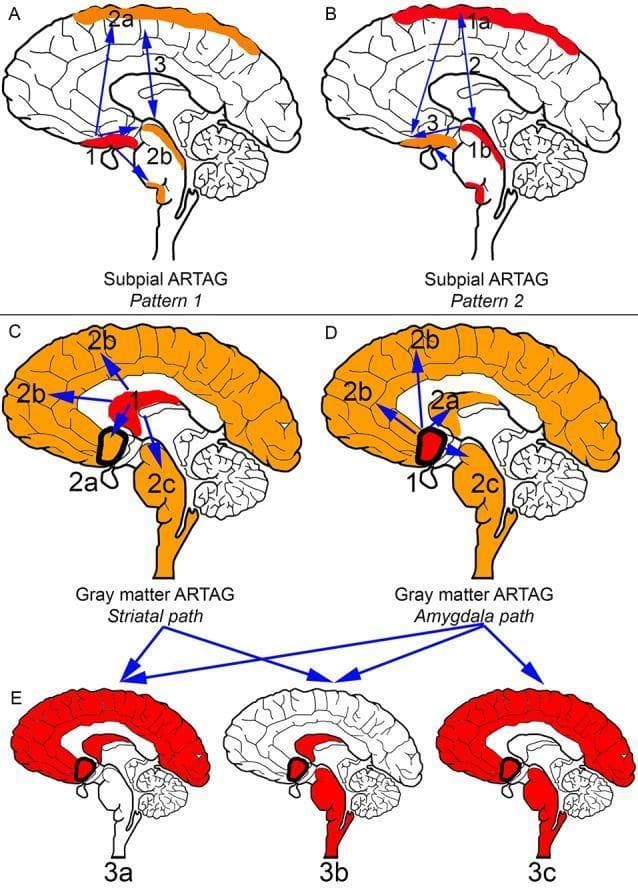 This medical illustration depicts the staging and progression patterns of Aging-Related Tau Astrogliopathy (ARTAG) in the human brain. The diagram is divided into five panels (A-E) showing subpial and gray matter distribution pathways. Red indicates initial involvement (Stage 1), while orange and blue arrows represent subsequent spread (Stages 2-3). Panels A and B illustrate subpial ARTAG: Pattern 1 begins in basal regions and spreads bidirectionally to lobar or brainstem areas; Pattern 2 starts in lobar/brainstem regions before involving the basal brain. Panels C, D, and E detail gray matter ARTAG progression. The 'Striatal path' (C) initiates in the striatum, spreading to the amygdala, cortex, or brainstem. The 'Amygdala path' (D) begins in the amygdala and follows similar trajectories. Panel E shows advanced Stage 3 combinations involving three regions simultaneously (3a: striatum/amygdala/cortex; 3b: striatum/amygdala/brainstem; 3c: amygdala/cortex/brainstem). This anatomical schematic serves as a neuropathological model for characterizing the hierarchical distribution of phosphorylated tau in astrocytes during brain aging.