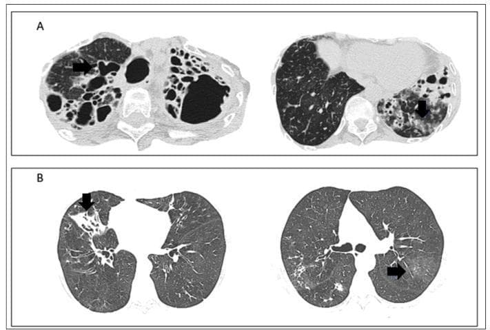 Diagnostic Image: This figure presents multiple axial high-resolution computed tomography (CT) scans of the chest from two different clinical cases of non-tuberculous mycobacteria lung disease (NTM-LD).
Panel A (Top): Displays axial slices of an immunocompromised patient with Mycobacterium asiaticum infection. Notable findings include severe, extensive varicose bronchiectasis characterized by significant bronchial dilation and bronchial wall (parietal) thickening, highlighted by black arrows. Also visible are areas of centrilobular opacities with ground-glass attenuation, indicating small-airway involvement.
Panel B (Bottom): Shows axial slices from a patient with Mycobacterium avium-intracellulare (MAC) complex. The left slice demonstrates focal consolidation and associated bronchiectasis localized to the right middle lobe. The right slice highlights ground-glass centrilobular opacities in the lingula and lower lobes (black arrows).
Educational Significance: These images demonstrate typical radiological patterns of NTM-LD, including the 'nodular bronchiectatic' form which often involves the middle lobe and lingula, and the more severe cavitary/varicose form seen in immunocompromised states.