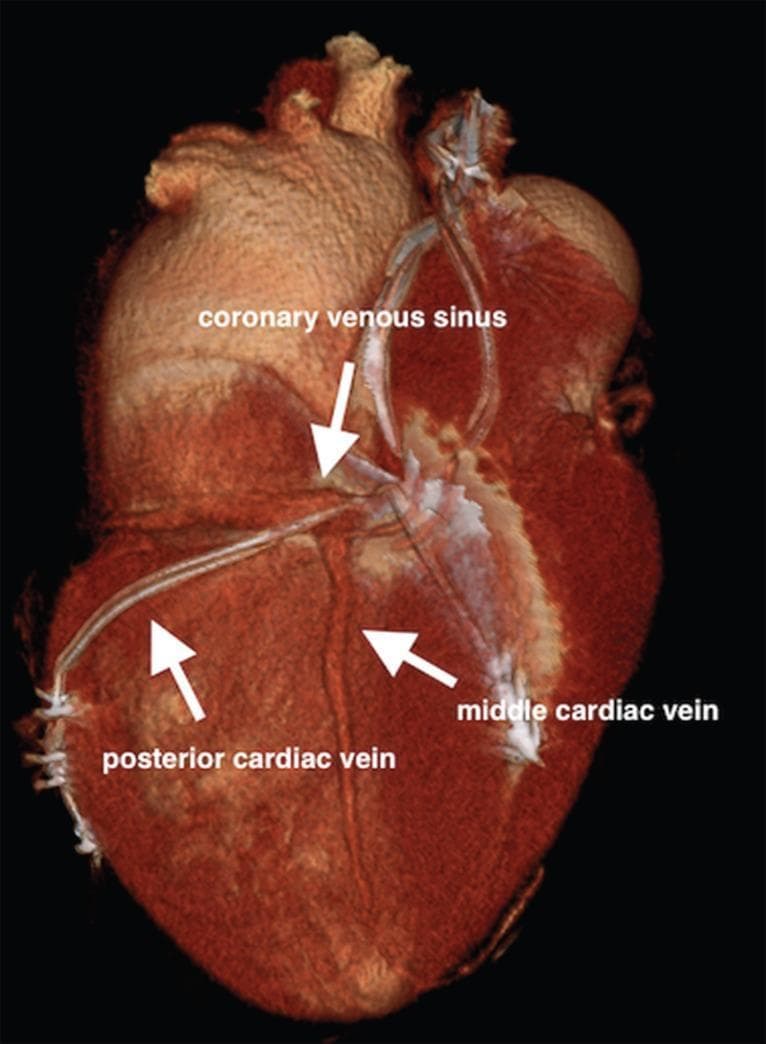 This diagnostic image is a 3D multi-slice computed tomography (MSCT) reconstruction of the heart, focusing on the cardiac venous anatomy and a cardiac resynchronization therapy (CRT) lead placement. The visualization highlights the coronary venous sinus, which extends across the posterior aspect of the atrioventricular groove. Labeled arrows identify the middle cardiac vein running along the posterior interventricular sulcus and the posterior cardiac vein positioned on the left ventricular wall. A notable clinical feature is the presence of a multipolar left ventricular lead successfully implanted within the posterior cardiac vein. The reconstruction demonstrates the complex anatomical relationships and distal anastomoses between these vessels. This clinical finding is significant for demonstrating a separate venous ostium and the use of the posterior vein as an alternative route for CRT lead placement when traditional cannulation of the coronary sinus is anatomically challenging.