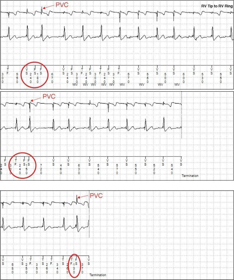 This diagnostic image displays three segments of intracardiac electrogram (EGM) tracings and surface ECG leads, likely recorded from an Implantable Cardioverter Defibrillator (ICD). The primary tracing, labeled 'RV Tip to RV Ring,' illustrates cardiac electrical activity during an episode of non-sustained ventricular tachycardia (NSVT) and frequent premature ventricular contractions (PVCs). Red arrows highlight specific PVCs characterized by wide QRS morphology. The lower portion of each strip includes digital marker annotations common in cardiac rhythm management devices: 'S' (Sensing), 'F' (Fibrillation detection), and 'V' (Ventricular event). The label 'WV' indicates the application of a wavelet discrimination algorithm used to differentiate supraventricular tachycardia from ventricular tachycardia to prevent inappropriate therapy. Numerical values represent R-R and V-V intervals in milliseconds. The segments demonstrate a lead integrity alert (LIA) triggered by rapid R-R intervals (<220 ms) and T-wave oversensing (TWOS) leading to short V-V intervals (<140 ms). The clinical relevance of this image is to demonstrate device-based arrhythmia detection, the use of discrimination algorithms, and the identification of potential sensing artifacts like TWOS in cardiology.