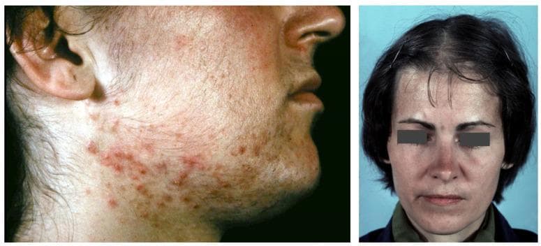 A composite clinical photograph illustrating dermatological manifestations of hyperandrogenism, specifically in the context of Polycystic Ovary Syndrome (PCOS). The left image provides a lateral view of the lower face and neck of a female patient, showing inflammatory acne vulgaris characterized by a dense distribution of erythematous papules and pustules along the jawline, mandibular area, and upper neck. Significant hirsutism is also visible, with terminal hair growth in androgen-dependent areas such as the preauricular region and chin. The right image is a frontal view of a female patient exhibiting androgenetic alopecia. Notable features include a receding frontal hairline with temporal sparing, resulting in an 'M' shaped pattern, along with diffuse thinning of the hair on the vertex and mid-scalp. Together, these images demonstrate the cutaneous 'SAHA' syndrome (seborrhea, acne, hirsutism, and alopecia) associated with systemic androgen excess, providing a key educational example for endocrine-related skin disorders.