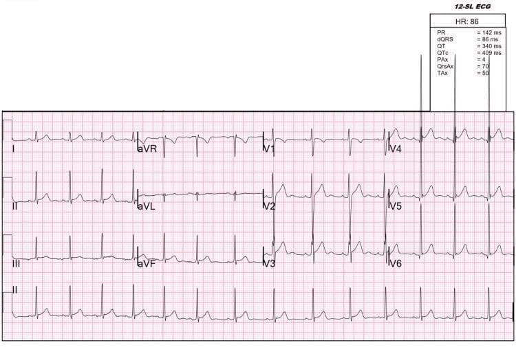 A 12-lead electrocardiogram (ECG) recorded on standard pink grid paper, demonstrating a normal sinus rhythm with a heart rate of 86 beats per minute. The tracing shows a consistent 1:1 relationship between P waves and QRS complexes. Key intervals reported in the data summary include a PR interval of 142 ms, QRS duration of 86 ms, and a corrected QT (QTc) of 409 ms. The ECG specifically illustrates the near-complete resolution of pathological U waves, which were previously associated with severe hypokalemia in a case of thyrotoxic periodic paralysis. Residual, faint U waves are still identifiable in the precordial leads, specifically V2 through V5, appearing as small positive deflections following the T waves. There are no significant ST-segment deviations or pathological Q waves. This visual is representative of cardiac repolarization changes during the recovery phase of metabolic and electrolyte disturbances related to hyperthyroidism.