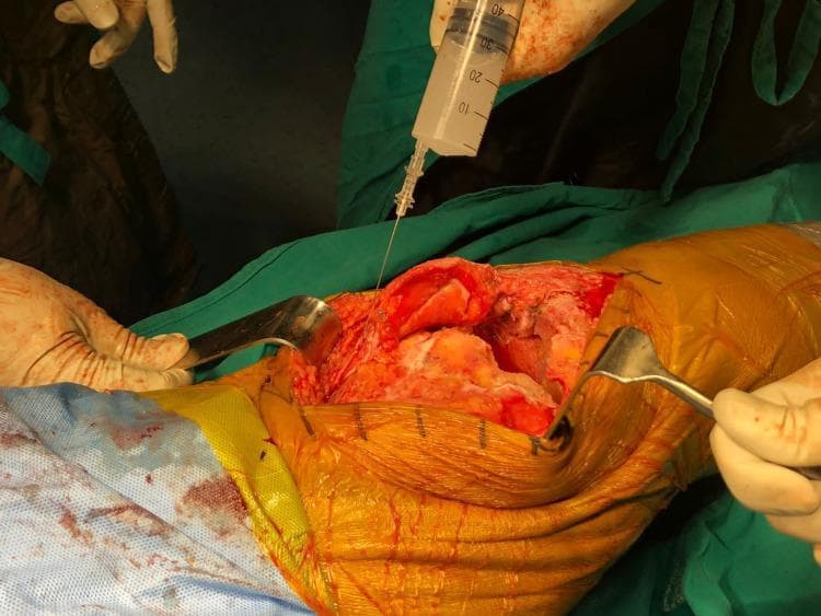 This clinical photograph captures an intraoperative surgical procedure on a human knee joint, likely during a total knee arthroplasty. The image displays an open surgical site with deep tissue exposure, where metallic surgical retractors are being used to maintain visualization of the periarticular structures. A clinician is performing a local infiltration analgesia (LIA) technique, utilizing a large-volume syringe (approximately 40-50 mL capacity) filled with a clear medicinal cocktail, such as ropivacaine. The solution is being administered via a long, thin-gauge spinal needle into the lateral sleeve of the joint capsule and surrounding soft tissues. The surgical field is prepared with sterile amber-colored iodine-based adhesive drapes and standard green and blue surgical draping. The hands of the surgical team are visible in sterile gloves, highlighting the precise administration of multimodal analgesia aimed at reducing postoperative pain and opioid consumption. This visual serves as a clinical demonstration of periarticular injection sites and surgical pain management protocols in orthopedic surgery.