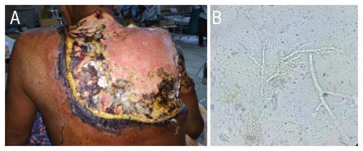 This composite educational image illustrates the clinical and laboratory findings of a severe fungal infection. Panel A is a clinical photograph showing an extensive necrotising wound on the upper back of a 60-year-old male. The lesion displays a heterogeneous wound bed with significant black necrotic eschar at the periphery, yellowish slough, and areas of central erythema and granulation tissue. The margins are irregular and appear undermined, consistent with creeping necrosis into subcutaneous tissues. Panel B is a diagnostic micrograph featuring a potassium hydroxide (KOH) mount of a biopsy from the lesion. It reveals hyaline, broad, aseptate fungal hyphae characterized by wide-angle (approximately 90-degree) branching. These morphological features are highly characteristic of mucormycosis, such as that caused by Apophysomyces species. The image demonstrates the clinical presentation of necrotising fasciitis and the essential microscopic diagnostic criteria for identifying invasive molds in a clinical dermatology or infectious disease context.