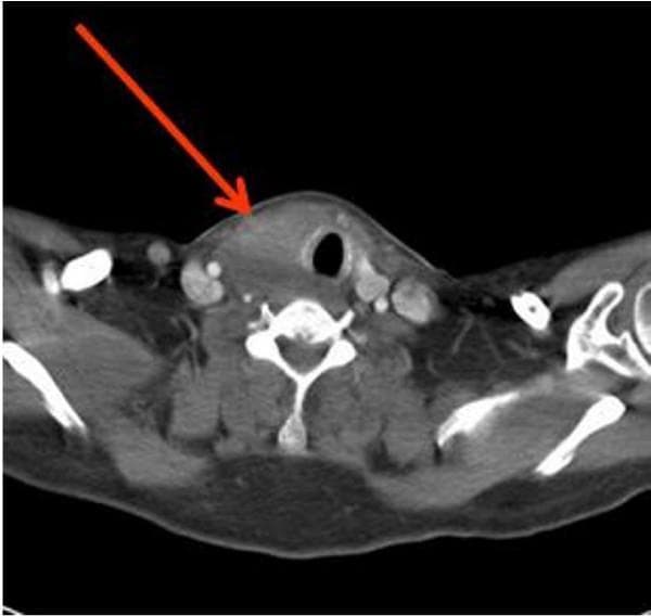 This diagnostic axial contrast-enhanced CT scan of the neck and thoracic outlet demonstrates a significant, asymmetric enlargement of the thyroid gland, indicated by a red arrow. The large thyroid mass predominantly involves the right lobe and exhibits heterogeneous enhancement. It exerts a clear mass effect, resulting in marked lateral deviation of the air-filled trachea toward the left side. Surrounding cervical anatomy is visible, including the cervical vertebrae and major vascular structures such as the carotid arteries and internal jugular veins, which appear in close proximity to the infiltrative mass. The image illustrates the clinical presentation of an invasive cervical process, consistent with pathology such as Riedel's thyroiditis or anaplastic carcinoma. This imaging modality is used to evaluate goitre progression, airway patency, and the involvement of adjacent neurovascular structures in the neck.