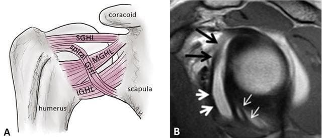 This educational image set illustrates the anatomy of the glenohumeral ligaments, focusing on the fasciculus obliquus (spiral glenohumeral ligament).
Image A is an anatomical diagram of the anterior shoulder joint, labeling the Superior Glenohumeral Ligament (SGHL), Middle Glenohumeral Ligament (MGHL), Inferior Glenohumeral Ligament (IGHL), and the Spiral GHL (fasciculus obliquus) crossing between the humerus and scapula.
Image B is a sagittal oblique PD-weighted MR arthrogram of the shoulder, demonstrating clinical correlation. Black arrows point to the Middle Glenohumeral Ligament (MGHL), which presents as a low-signal (dark) band. Thick white arrows indicate the fasciculus obliquus located inferiorly. Thin white arrows highlight the frenula capsulae (synovial bands) within the axillary recess. The contrast-enhanced joint fluid helps delineate these capsuloligamentous structures. This comparison is useful for musculoskeletal radiology and orthopedic surgery to understand shoulder stability and the visualization of anatomical variants during arthrography.