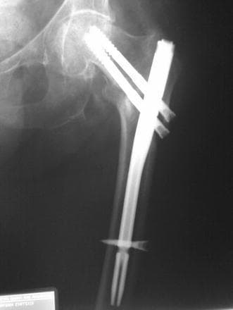 This anteroposterior (AP) diagnostic X-ray of the proximal femur illustrates a post-surgical state following the treatment of an intertrochanteric fracture with a cephalomedullary nail. The orthopedic construct consists of a radiopaque intramedullary nail positioned within the femoral canal. Two cephalic lag screws are inserted through the proximal portion of the nail, extending into the femoral head and neck to provide rotational stability and compression. A notable technical finding is visualized distally: the distal locking screws appear to have missed the nail's locking aperture, as they are seen passing adjacent to the nail rather than through it. Despite this malpositioning, the overall alignment of the femur appears maintained. The image serves as a clinical teaching example for identifying technical complications during intramedullary nailing, specifically the 'missed' distal locking screw, and assessing the relationship between orthopedic implants and native bone anatomy in the context of fracture fixation.
