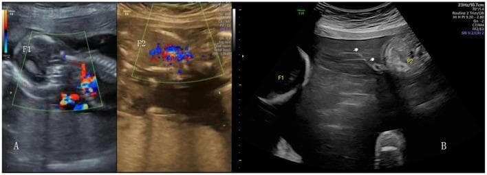 Educational diagnostic ultrasound images demonstrating complications in a monochorionic multifetal pregnancy. Panel A shows a color Doppler ultrasound assessment of surviving fetuses (labeled F1 and F2) following radiofrequency ablation (RFA). The green-bordered boxes highlight vascular flow, with red and blue signals indicating directionality of blood flow in umbilical or placental vessels. Panel B presents a B-mode ultrasound of Twin-Twin Transfusion Syndrome (TTTS), illustrating fetal discordance. Fetus F1 is situated in a polyhydramnios environment (recipient twin), while fetus F2 is shown within a restricted amniotic space. White arrows indicate the 'stuck' donor amnion or dividing membrane floating in the amniotic cavity, a hallmark of TTTS. These images demonstrate key sonographic markers used in fetal medicine to diagnose and monitor complications such as TTTS, selective fetal growth restriction (sFGR), and the post-procedural state after fetal reduction in monochorionic pregnancies.