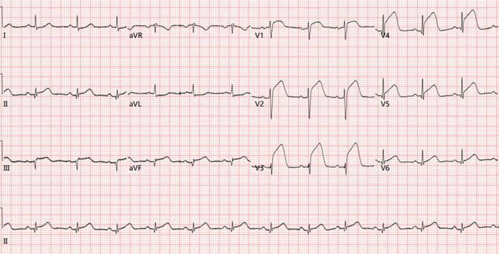 This diagnostic image is a 12-lead electrocardiogram (ECG) demonstrating an acute ST-segment elevation myocardial infarction (STEMI) with extensive involvement. The tracing reveals significant ST-segment elevation in the inferior leads (II, III, and aVF) and the precordial leads (V1 through V5), indicating a combined anterior and inferior wall infarction pattern. Prominent pathological Q-waves are visible in the limb leads I, II, III, and aVF, signifying established myocardial necrosis or a prior infarctive event in those territories. The precordial leads show a 'tombstoning' morphology of the ST segments, particularly from V2 to V4, where the ST elevation merges directly with the T-waves. These findings are consistent with massive myocardial ischemia and infarction, typically necessitating urgent reperfusion therapy. The ECG serves as an educational tool for identifying multivessel or proximal coronary artery occlusion patterns and the evolution of ischemic changes from Q-wave formation to acute ST-segment deviation.