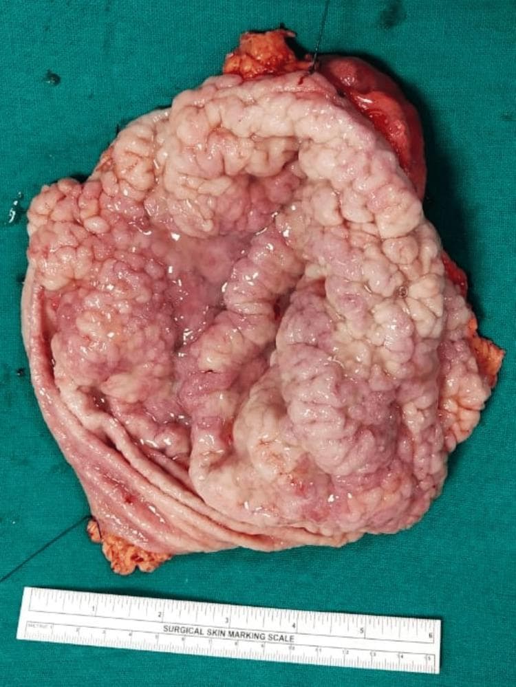 This clinical photograph displays a gross pathological specimen of a cut-open total gastrectomy. The image captures the internal mucosal surface of the stomach, which exhibits marked, diffuse hypertrophy of the gastric rugae. These folds are grossly thickened, firm, and convoluted, resulting in a distinct 'cerebriform' or brain-like appearance, characteristic of Menetrier's disease (hypoproteinemic hypertrophic gastropathy). The mucosal surface appears glistening and lobulated with varied coloration ranging from pale pink to deeper red, suggesting focal areas of congestion or vascular changes. A surgical skin marking scale at the bottom provides a size reference, indicating the specimen's longitudinal dimension is approximately 15 cm. This visual demonstrates severe foveolar hyperplasia and mucosal thickening without an obvious localized mass, contrasting with the typical appearance of gastric adenocarcinoma or lymphoma. The specimen serves as a classic educational example of hypertrophic gastropathy in a surgical pathology context.