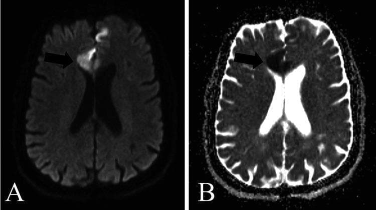 This diagnostic image displays a side-by-side comparison of axial brain MRI sequences, specifically Diffusion-Weighted Imaging (DWI) (A) and the corresponding Apparent Diffusion Coefficient (ADC) map (B). The images demonstrate bilateral frontal lobe pathology, characterized by focal areas of hyperintensity on DWI (A) and corresponding hypointensity on the ADC map (B). This visual pattern represents 'true diffusion restriction,' a finding commonly associated with cytotoxic edema, acute ischemic stroke, or inflammatory processes such as encephalitis. Anatomical landmarks including the lateral ventricles, cerebral hemispheres, and interhemispheric fissure are visible. In the DWI sequence, the ventricles appear hypointense, whereas in the ADC map, the cerebrospinal fluid exhibits high signal intensity. The visual evidence of restricted diffusion in the frontal regions serves as a critical diagnostic indicator for acute neurological conditions requiring immediate clinical correlation.