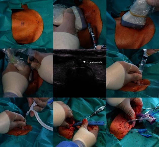 A multi-panel clinical photograph and diagnostic montage illustrating the step-by-step procedure of an ultrasound-guided percutaneous dilatational tracheostomy (PDT). The sequence begins with preoperative skin marking of the cricoid cartilage and sternal notch, followed by local anesthetic infiltration. A central axial ultrasound image depicts the thyroid isthmus (labeled 'I') and a hyperechoic guide needle positioned for tracheal entry. Surgical panels show the transition from needle insertion to guidewire placement via the Seldinger technique. Subsequent frames demonstrate the use of the Ciaglia Blue Rhino kit, showing progressive tracheal dilatation over the guidewire using a curved, tapered dilator. The final panels exhibit the insertion and securing of the tracheostomy tube (T-tube). The image highlights the integration of real-time imaging with surgical maneuvers to enhance safety by visualizing the cervical vasculature, thyroid anatomy, and endotracheal tube positioning during the procedure. This educational material is intended for advanced medical training in critical care, anesthesiology, or otolaryngology.