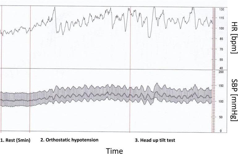 This diagnostic line graph displays a real-time beat-to-beat analysis of heart rate (HR) and systolic blood pressure (SBP) in a patient with COVID-19 and low baroreflex sensitivity. The data is divided into three clinical phases: 1. Rest (5 min), 2. Orthostatic hypotension (active standing), and 3. Head up tilt test. The upper panel shows the HR in beats per minute (bpm), showing an upward trend and increased variability from a baseline of ~95 bpm at rest to over 115 bpm during postural challenges. The lower panel displays SBP in mmHg, oscillating between 100 and 150 mmHg. A central line indicates mean SBP, while a surrounding shaded area represents the beat-to-beat variability or standard deviation. The visual demonstrates impaired autonomic nervous system (ANS) regulation, characterized by significant fluctuations in hemodynamic parameters during orthostatic stress. This educational tool illustrates the cardiovascular response to autonomic provocation in the context of post-viral dysautonomia.