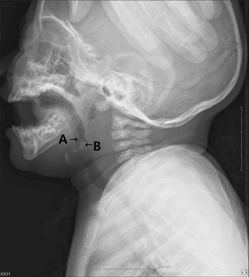 This lateral soft tissue X-ray of a pediatric neck demonstrates a significant upper airway obstruction caused by a mass at the level of the oropharynx. Label 'A' points to an elongated uvula, while label 'B' indicates a well-defined, radiopaque mass identified as a uvular epidermoid cyst. The mass occupies a substantial portion of the airway lumen, mimicking the 'thumbprint sign' typically associated with epiglottitis, although the epiglottis itself remains non-swollen. Secondary findings include diffuse thickening of the prevertebral soft tissues and anterior displacement of the airway column. This diagnostic image illustrates a rare cause of neonatal/infant respiratory distress, highlighting the importance of radiographic evaluation in pediatric airway management to differentiate between infectious etiologies like epiglottitis and mechanical obstructions such as benign keratinous cysts.