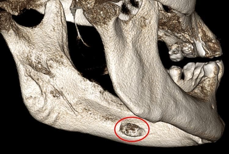 This diagnostic image is a 3D volume-rendering reconstruction of the human mandible, viewed from a posterolateral perspective focusing on the left lingual cortical surface. The primary clinical finding is a well-defined, oval-shaped concavity (highlighted by a red circle) located on the medial aspect of the mandibular body, inferior to the expected pathway of the inferior alveolar canal. While the surrounding lingual cortical bone appears dense and smooth, the bone within this indentation demonstrates an irregular, trabecular-like texture. This anatomical variation is characteristic of a Stafne defect (static bone cyst), which represents a developmental depression created by the submandibular salivary gland. The image serves as an educational tool for distinguishing benign developmental anomalies from pathological intraosseous lesions in oral and maxillofacial radiology. The anatomical landmarks shown include the mandibular ramus, angle, and body, providing context for the atypical anterior location of this specific defect.