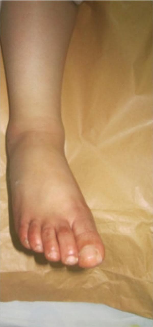 This clinical photograph shows an anterior view of the right foot and lower leg following the closed reduction of a medial subtalar dislocation. The image demonstrates restored anatomical alignment of the foot relative to the leg, resolving the previous clubfoot-like deformity. Significant soft tissue swelling (edema) is visible around the ankle joint and dorsum of the foot, which is a common finding post-trauma and post-reduction. The skin remains intact with no evidence of open wounds or ulcerations. The toes are neutrally aligned in a forward-facing position, and the hallux appears anatomically positioned. This image serves as a visual record of successful conservative management for a high-energy foot injury, highlighting the importance of immediate reduction to prevent skin necrosis and long-term neurovascular complications in subtalar dislocations.