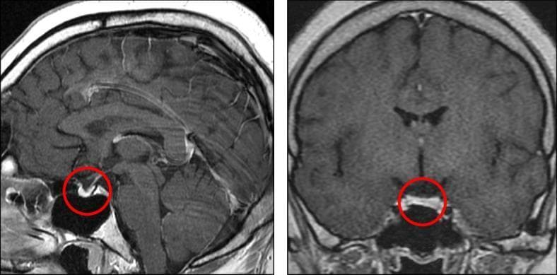 This diagnostic image consists of two panels showing a gadolinium-enhanced brain MRI in sagittal (left) and coronal (right) planes, specifically targeting the sella turcica region. The primary finding, indicated by red circles, is anterior pituitary hypoplasia. The anterior lobe of the pituitary gland appears significantly reduced in volume and height compared to standard anatomical expectations, resulting in a flattened morphology within the sella. In contrast, the posterior pituitary is visible as a hyperintense 'bright spot' on these T1-weighted images, which is a normal finding. The pituitary stalk appears midline and intact without evidence of ectopic posterior pituitary or interruption. This imaging is characteristic of combined pituitary hormone deficiency (CPHD), where underdevelopment of the adenohypophysis correlates with multi-lineage endocrine dysfunction. No other intracranial abnormalities or midline defects are visualized in these views. The scans are relevant for neuroradiology and endocrinology, illustrating the structural correlates of hypopituitarism.