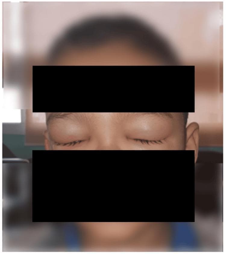 Clinical photograph of a pediatric patient's face, specifically focusing on the periorbital region. The image demonstrates significant bilateral eyelid edema, characterized by puffy and distended upper and lower eyelids. The swelling is severe enough to cause the involuntary closure of both eyes. The overlying skin appears tense and smooth due to the underlying fluid accumulation. This finding is presented in the context of Henoch-Schönlein purpura (HSP) and subsequent IgA nephropathy, illustrating systemic manifestations of small-vessel vasculitis. The educational focus is on identifying periorbital swelling as a clinical sign that may be associated with pediatric renal complications, such as proteinuria or hypoalbuminemia. Black bars are placed across the forehead and mid-face for patient privacy.