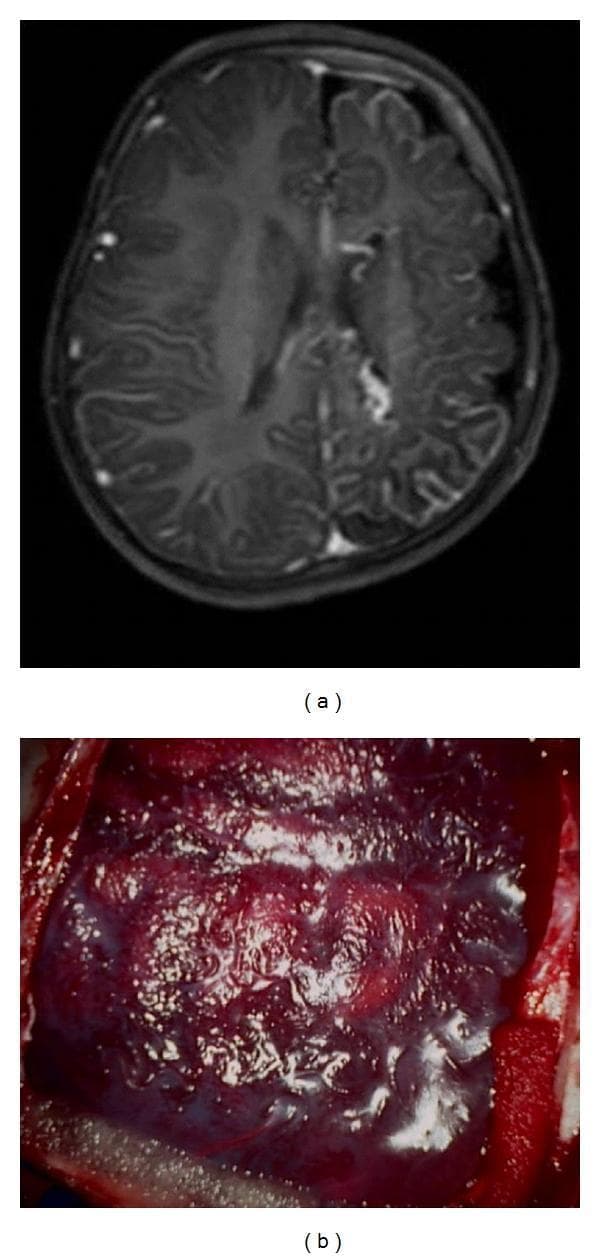 This composite image illustrates diagnostic and surgical findings of Sturge-Weber syndrome (SWS). (a) T1-weighted axial gadolinium-enhanced MRI of the brain: The left hemisphere demonstrates hallmark features of leptomeningeal angiomatosis, characterized by irregular, intense contrast enhancement and thickening of the leptomeninges. This is accompanied by ipsilateral sulcal prominence and hemispheric atrophy compared to the right side. (b) Intraoperative photograph: A direct view of the cortical surface revealing a dense, hypervascular pial angioma. The brain surface exhibits a deep reddish-purple discoloration due to engorged, tortuous abnormal vessels. The presence of these lesions is clinically significant in pediatric neurosurgery for managing refractory epilepsy, often requiring procedures like peri-insular functional hemispherectomy to disconnect the affected cortical tissue. The images provide a correlation between radiological evidence of pial enhancement and the physical presentation of vascular malformations on the cerebral cortex.