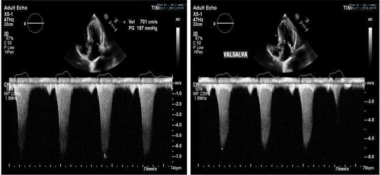 This diagnostic image consists of two panels showing transthoracic echocardiography (TTE) using continuous-wave (CW) spectral Doppler across the left ventricular outflow tract (LVOT). The left panel represents the 'at rest' state, and the right panel represents the 'Valsalva' maneuver. The 2D apical view at the top shows significant concentric left ventricular hypertrophy and septal thickening. Below, the spectral Doppler waveforms display high-velocity, late-peaking systolic jets characteristic of dynamic outflow obstruction. In the 'at rest' panel, the peak velocity is measured at 701 cm/s with a corresponding peak gradient (PG) of 197 mmHg. The 'Valsalva' panel demonstrates a slightly altered waveform morphology and increased peak pressure gradient (reaching 200 mmHg), indicative of hypertrophic obstructive cardiomyopathy (HOCM) physiology. This comparison illustrates the dynamic nature of LVOT obstruction, where provocative maneuvers like the Valsalva maneuver can exacerbate pressure gradients by reducing preload. This material is designed for advanced medical education in cardiology and diagnostic imaging.