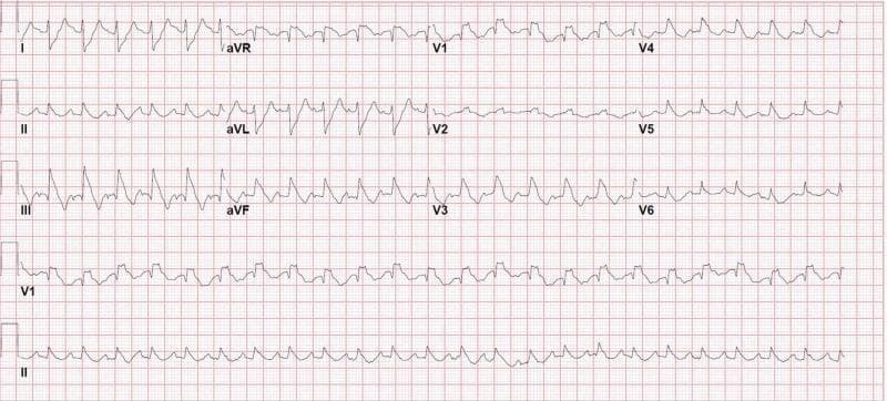 A 12-lead electrocardiogram (ECG) demonstrating an irregularly irregular rhythm with a rapid ventricular response, characteristic of atrial fibrillation. Notable features include the absence of distinct P waves and varying R-R intervals. The ventricular rate is tachycardia, estimated at over 150 bpm. A widening of the QRS complex is observed, exceeding 120 ms. In the precordial leads V1-V3, there is a prominent RSR' pattern, where the terminal R wave is taller than the initial R wave, coupled with secondary ST-segment depression and T-wave inversion. Leads V5 and V6 exhibit characteristic slurred S waves. These morphological findings are diagnostic of a right bundle branch block (RBBB). This diagnostic image is clinically significant for identifying acute right ventricular strain or conduction disturbances in the context of emergency presentations such as syncope or suspected pulmonary embolism. It is suitable for medical students and clinicians studying cardiovascular diagnostics and acute care.