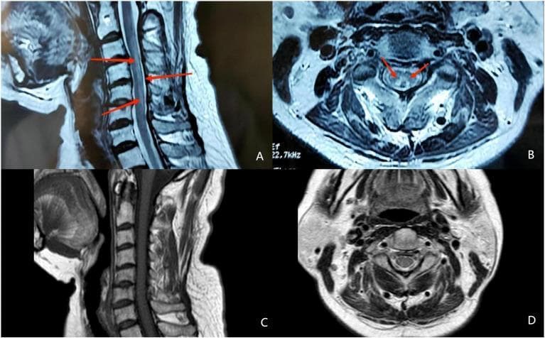 This composite diagnostic image features four MRI panels (A-D) demonstrating subacute combined degeneration of the cervical spinal cord. Panel A is a sagittal T2-weighted MRI showing a longitudinally extensive hyperintense signal within the posterior columns (indicated by red arrows). Panel B displays an axial view at the cervical level, revealing bilateral hyperintensities in the posterior columns that form the characteristic 'inverted V' or 'rabbit ears' sign (red arrows). This pattern is a classic radiological marker for vitamin B12 deficiency and posterior column myelopathy. Panels C (sagittal) and D (axial) represent post-treatment follow-up imaging, demonstrating the complete resolution of the previously seen abnormal hyperintensities. The images serve as an educational comparison of acute pathology versus radiological recovery after therapeutic intervention. These findings are relevant for neurology and radiology students studying metabolic myelopathies and differential diagnoses of spinal cord lesions.