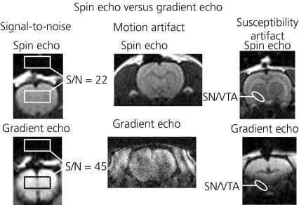 This comparison chart displays a series of magnetic resonance imaging (MRI) scans of a rodent brain, designed to demonstrate the technical differences between spin echo (SE) and gradient echo (GE) pulse sequences. The educational content is organized into three categories: Signal-to-noise (S/N), Motion artifact, and Susceptibility artifact.
In the S/N comparison, the spin echo sequence shows a S/N ratio of 22, while the gradient echo sequence shows a significantly higher S/N of 45, though with increased background graininess. The motion artifact panels reveal that spin echo maintains clearer anatomical definitions, whereas the gradient echo image displays visible blurring and geometric distortion.
The third section highlights susceptibility artifacts, particularly in the substantia nigra (SN) and ventral tegmental area (VTA) regions. While the spin echo sequence preserves signal in these areas, the gradient echo sequence exhibits significant signal dropout and blurring at these anatomical landmarks. This comparison serves as a clinical teaching tool for understanding pulse sequence selection in neuroimaging, emphasizing that while GE offers higher sensitivity (beneficial for fMRI and BOLD imaging), it is more prone to artifacts compared to the robust anatomical clarity of SE.
