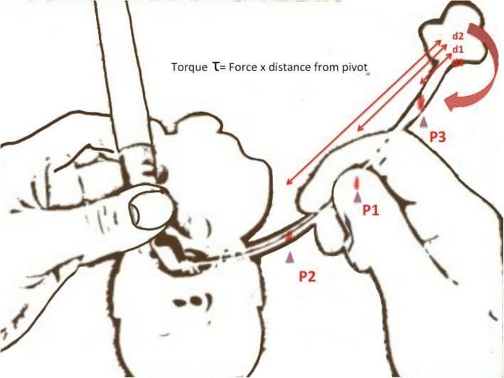 This medical illustration demonstrates the physics of torque during endotracheal intubation. The diagram shows a clinician's hands manipulating an endotracheal tube (ETT) through a patient's mouth using a laryngoscope. The focus is on the biomechanics of tube tip control. Three specific holding points on the ETT are labeled: P1 (proximal), P2 (middle), and P3 (distal, furthest from the tip). Annotations include the formula 'Torque τ = Force x distance from pivot'. Red arrows indicate the distance (d1, d2) from holding points to the distal tip. A large red curved arrow at the tip represents the ease of rotation. The educational purpose is to illustrate that as the holding point (pivot) moves further from the tip (e.g., at P3), the mechanical advantage increases, allowing for finer, more effortless adjustments of the tube tip movement toward the glottic opening. This concept is vital for anesthesiology and emergency medicine trainees to improve intubation success rates and maneuverability.