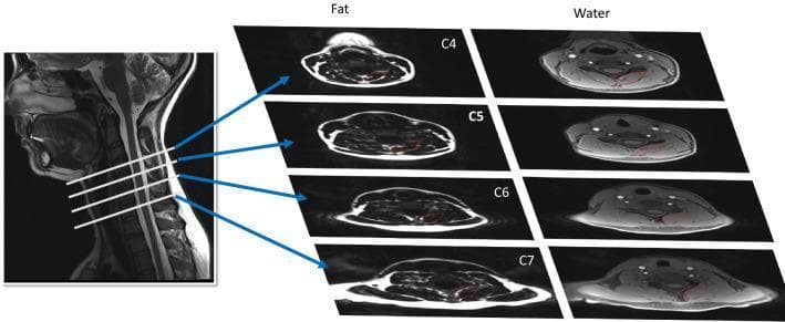 This diagnostic image demonstrates a comparative fat/water MRI study of the deep cervical extensor muscles (multifidus and semispinalis cervicis) across the C4 to C7 vertebral levels. On the left, a sagittal T2-weighted MRI of the cervical spine serves as a reference, with horizontal white lines and blue arrows indicating the specific axial slice locations. To the right, two columns of axial images illustrate the results of a 2-point Dixon sequence: the 'Fat' column highlights high-signal (bright) areas of muscle fat infiltration (MFI), while the 'Water' column displays corresponding water-signal images. Red outlines on the axial views delineate the manual segmentation of the dorsal muscle groups for quantitative analysis. This visual material is used in clinical research to assess muscle composition changes in patients following whiplash-associated disorders (WAD). The presentation emphasizes the anatomical distribution of intramuscular adipose tissue, which is a key biomarker for cervical spine pathology and functional recovery post-injury.