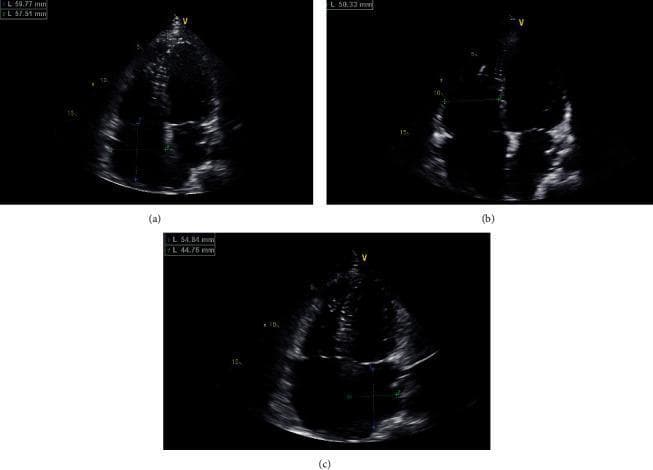 Transthoracic echocardiography images in the apical four-chamber view demonstrating significant chamber enlargement in a patient with a confirmed EMD gene mutation. Image (a) focuses on the right atrium, measuring approximately 59.77 mm by 57.51 mm, indicating severe bi-atrial dilation. Image (b) shows the right ventricle with a measured diameter of roughly 50.33 mm. Image (c) visualizes the left atrium with dimensions of 54.84 mm by 44.76 mm. The images illustrate cardiac structural changes often associated with Emery-Dreifuss muscular dystrophy, including atrial enlargement and secondary ventricular dilation, which may clinically present with arrhythmias such as atrial flutter or atrioventricular block. The modality highlights the use of diagnostic ultrasound for assessing cardiac morphology and chamber dimensions in hereditary myopathies.