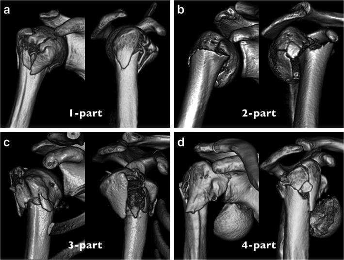 A comparison chart consisting of four 3D CT reconstructions (a-d) of the proximal humerus, illustrating the modified Neer classification system for humeral fractures based on fragment displacement and angulation. Each panel shows two views of the shoulder joint to demonstrate spatial relationships between the humeral head, greater tuberosity, lesser tuberosity, and humeral shaft. (a) 1-part fracture: Minimal to no displacement or angulation between segments; the humeral head maintains alignment with the shaft and tuberosities. (b) 2-part fracture: Visible fracture line with rotation or displacement (>1cm or >45°) of the humeral head and tuberosities relative to the shaft. (c) 3-part fracture: Separation involving three segments, typically with the humeral head detached from both the shaft and the greater tuberosity. (d) 4-part fracture: Complete detachment and significant displacement of the humeral head from the other three proximal humeral segments (shaft, greater, and lesser tuberosities). This visual resource is intended for orthopedic surgical education, specifically for classifying fracture severity and assessing articular surface vascular risk.