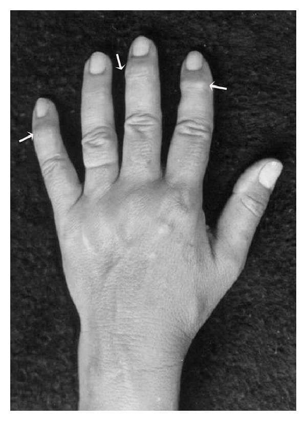 This clinical photograph displays a dorsal view of a human hand, specifically highlighting manifestations of primary osteoarthritis. The image demonstrates characteristic bony enlargements known as Heberden's nodes, located at the distal interphalangeal (DIP) joints. These nodes are indicated by white arrows and appear as firm, rounded protuberances or osteophytes on the index, middle, and little fingers. The anatomical focus is on the small joints of the hand, illustrating typical degenerative joint disease changes. The skin overlying the joints appears normal without acute inflammatory signs like erythema, though the prominence of the nodes suggests chronic remodeling of the subchondral bone. This visual is a classic educational example of osteoarthritis of the hands, distinguishing it from rheumatoid arthritis which typically affects the proximal interphalangeal and metacarpophalangeal joints. The image serves as a clinical reference for physical examination findings in rheumatology and geriatrics.