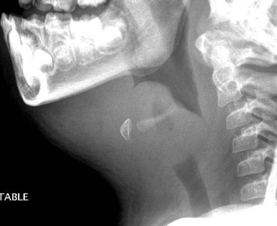 This lateral soft tissue neck radiograph depicts a classic presentation of acute epiglottitis in a pediatric patient. The primary finding is a markedly enlarged and swollen epiglottis, demonstrating the characteristic 'thumbprint sign' (or thumb sign). The epiglottis appears bulbous and radiopaque, significantly deviating from its normal thin, leaf-like morphology. This massive swelling results in a critical narrowing and nearly complete obstruction of the supraglottic airway. Additionally, there is evidence of thickening in the aryepiglottic folds and generalized prevertebral soft tissue edema. The surrounding cervical spine and mandible appear within normal limits for age. This diagnostic image illustrates the severe anatomical distortion associated with Haemophilus influenzae infection, highlighting the clinical emergency of airway compromise in pediatric epiglottitis.