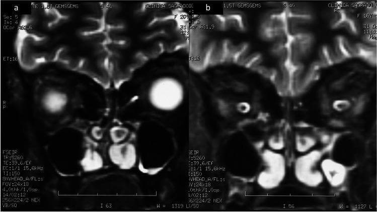 Two coronal magnetic resonance imaging (MRI) scans of the brain (labeled a and b) focusing on the anterior cranial fossa and olfactory region. The images demonstrate aplasia of the olfactory bulbs and tracts, a hallmark radiological finding in Kallmann syndrome. Image (a) shows the inferior frontal lobes with altered signal intensity and a lack of distinct olfactory bulb morphology within the olfactory sulci. Image (b) further confirms the bilateral absence of these structures. The nasal cavities and ethmoid sinus regions are visible inferiorly with normal aeration (dark signal). The imaging demonstrates the key diagnostic feature for patients presenting with congenital hypogonadotropic hypogonadism and anosmia/hyposmia. This comparison illustrates the developmental abnormalities of the olfactory system associated with genetic neuroendocrine disorders.