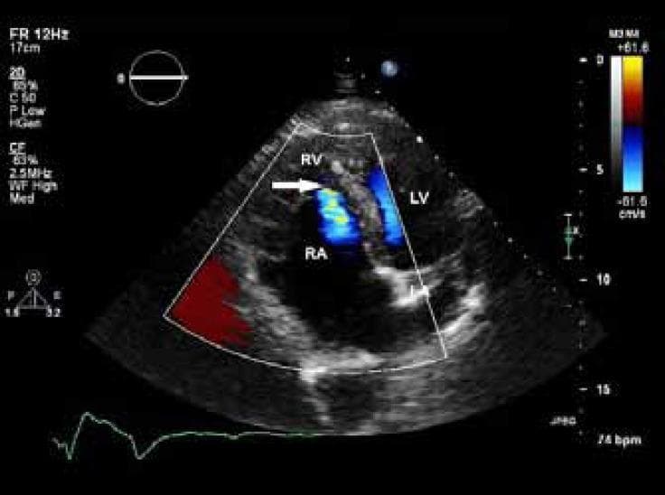 This diagnostic image is a transthoracic echocardiogram in the apical four-chamber view, utilizing color flow Doppler to evaluate cardiac hemodynamics. The visual demonstrates characteristic features of Ebstein’s anomaly, most notably the apical displacement of the septal leaflet of the tricuspid valve, which results in the 'atrialization' of the proximal portion of the right ventricle. There is significant dilation of both the right atrium (RA) and right ventricle (RV), with the RA appearing markedly enlarged compared to the left ventricle (LV). The color Doppler overlay reveals a blue-tinted regurgitant jet (indicated by a white arrow) moving from the right ventricle back into the right atrium, consistent with mild-to-moderate tricuspid regurgitation. A red zone at the periphery of the sector indicates flow towards the transducer. This image serves as an educational example of congenital right-sided heart disease and valvular pathology, illustrating the anatomical remodeling and functional consequences associated with tricuspid valve malformation.