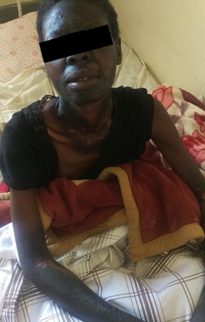 This clinical photograph displays classic dermatological manifestations of pellagra (niacin deficiency) in a patient with darker skin tones. The image depicts extensive, symmetric hyperpigmented and hyperkeratotic plaques distributed in sun-exposed areas. A prominent finding is 'Casal's necklace,' a well-demarcated band of hyperpigmented, thickened skin encircling the lower neck. Similar hyperpigmented lesions with visible scaling and fissuring are present on the face (forehead, nose, and malar regions) and the extensor surfaces of the forearms. The skin in these areas appears dry, rough, and desquamating, characteristic of photodermatitis secondary to nutritional deficiency. This visual record serves as a classic educational example of the '3 Ds' (dermatitis, diarrhea, dementia) presentation, specifically illustrating the characteristic cutaneous distribution patterns used to diagnose pellagra in a clinical setting.