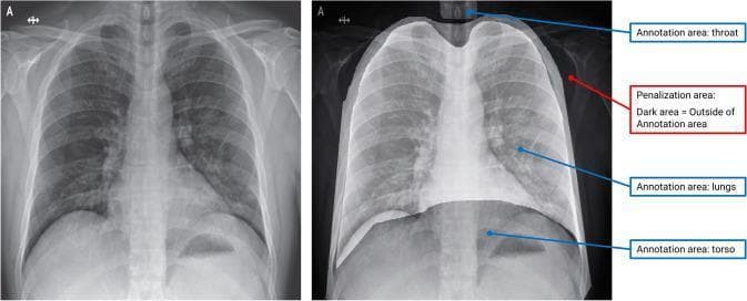 This figure presents a comparative study of X-ray radiography using an Explainable Interactive Machine Learning (XIL) optimization strategy. The visual is divided into two panels: a standard grayscale chest X-ray on the left and an annotated version on the right. The original X-ray displays typical thoracic anatomy, including the rib cage, lung parenchyma, and mediastinum. The annotated image on the right illustrates the implementation of binary masks used to guide machine learning models. Three specific 'Annotation areas' are labeled with blue arrows: the throat (superior aspect, upper airway), the lungs (bilateral thoracic cavity), and the torso (inferior aspect, abdominal region). These highlighted areas represent the relevant anatomical features the model should utilize for diagnostic prediction. Conversely, the regions outside these masks are darkened, identified by a red arrow as 'Penalization areas.' These dark zones signify regions the model is penalized for focusing on, effectively masking potential confounders such as skeletal maturity markers or external imaging artifacts. This approach demonstrates how human-in-the-loop expert knowledge can refine algorithmic focus in medical imaging.