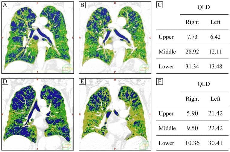 Educational comparison of Chronic Obstructive Pulmonary Disease (COPD) phenotypes using diagnostic imaging and quantitative data. Panels A-B and D-E display coronal CT scans with color-coded overlays representing lung density; blue areas indicate low-attenuation areas (LAA) characteristic of centrilobular emphysema. Case 1 (A-C) shows upper-lung-dominant emphysema during inspiration (A) and expiration (B), where lower lung volume decreases significantly more than upper volume. Case 2 (D-F) demonstrates nearly equal volume reduction in both lung zones during expiration (E). Adjacent tables (C and F) provide Quantitative Lung sound Distribution (QLD) values for upper, middle, and lower regions of the right and left lungs. The visual demonstrates the relationship between anatomical emphysema distribution (upper-lung dominant), dynamic hyperinflation (evidenced by volume changes on expiration CT), and functional lung sound intensity. This illustrates how differing mechanical properties of emphysematous lungs affect air distribution and acoustic findings, useful for differentiating COPD severity and phenotypes.