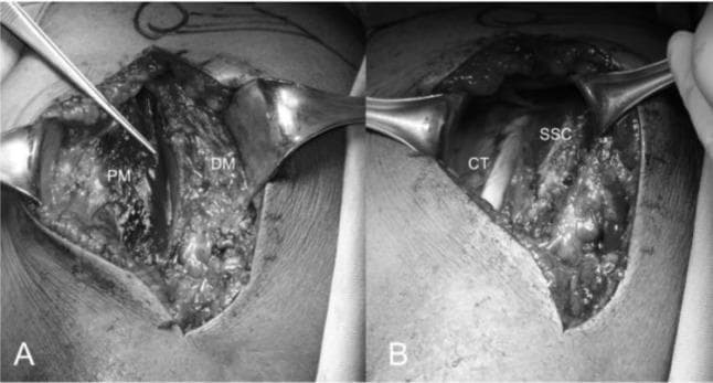 This composite clinical photograph (Figures 10A and 10B) illustrates the surgical anatomy of the deltopectoral approach during a shoulder arthroplasty procedure. Figure 10A demonstrates the deltopectoral interval, showing the anatomical separation between the pectoralis major (PM) muscle medially and the deltoid muscle (DM) laterally. The cephalic vein is visible within this interval, serving as a critical landmark for surgical dissection. Metal retractors are used to expose the deeper muscular layers. Figure 10B reveals the underlying structures after further dissection and incision of the clavipectoral fascia. Labeled features include the conjoint tendon (CT), positioned laterally, and the subscapularis tendon (SSC), which is situated more medially and demonstrates a characteristically interwoven fibrous texture. This visual guide serves an educational role for orthopedic surgical training, highlighting key anatomical landmarks and tissue planes required for safe access to the glenohumeral joint during prosthetic replacement.