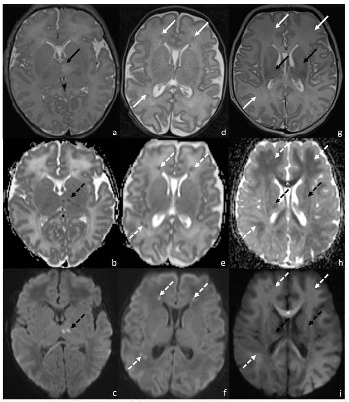 A multi-panel axial brain MRI compilation of neonatal patients demonstrating typical patterns of hypoxic-ischemic encephalopathy (HIE). The image is organized into three columns representing distinct injury patterns across T2-weighted (T2WI), Apparent Diffusion Coefficient (ADC), and Diffusion-Weighted Imaging (DWI) sequences. Pattern 1 (a-c) illustrates central involvement, highlighting focal hyperintensity on T2WI and diffusion restriction (low ADC, high DWI signal) in the left thalamus. Pattern 2 (d-f) demonstrates a watershed distribution, characterized by inhomogeneous signal alterations and diffusion restriction within the bilateral frontal and right parietal white matter. Pattern 3 (g-i) shows a mixed pattern involving both deep gray matter and peripheral structures, specifically showing restricted diffusion in the bilateral capsulo-lenticular regions, corpus callosum, and diffuse white matter areas. Arrows and asterisks facilitate the identification of pathological signal changes. This diagnostic image serves as a clinical reference for classifying neonatal HIE severity based on anatomical distribution (basal ganglia/thalamus vs. watershed areas).