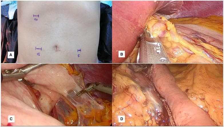This composite of four clinical images illustrates the abdominal phase of a three-port laparoscopic esophagectomy (Ivor Lewis procedure). Image (A) is a clinical photograph of a patient's abdomen showing preoperative markings for port placement: a 10-mm port at the right costal arch, a 15-mm port right lateral to the umbilicus, and a 5-mm port left lateral to the umbilicus. Images (B, C, D) are intraoperative laparoscopic views. Image (B) demonstrates the division of the left gastric vessels using an endoscopic linear vascular stapler, with the liver retracted to expose the celiac axis area. Image (C) illustrates a non-grasping technique using open-jaw retraction with a Babcock clamp to manipulate the stomach and visualize the gastrocolic ligament without tissue trauma. Image (D) shows the final view of the tubularized gastric conduit, characterized by longitudinal staple lines and shiny serosal tissue, prepared for intrathoracic pull-up. The series highlights surgical techniques for vascular control, atraumatic gastric mobilization, and conduit formation in minimally invasive esophageal surgery.