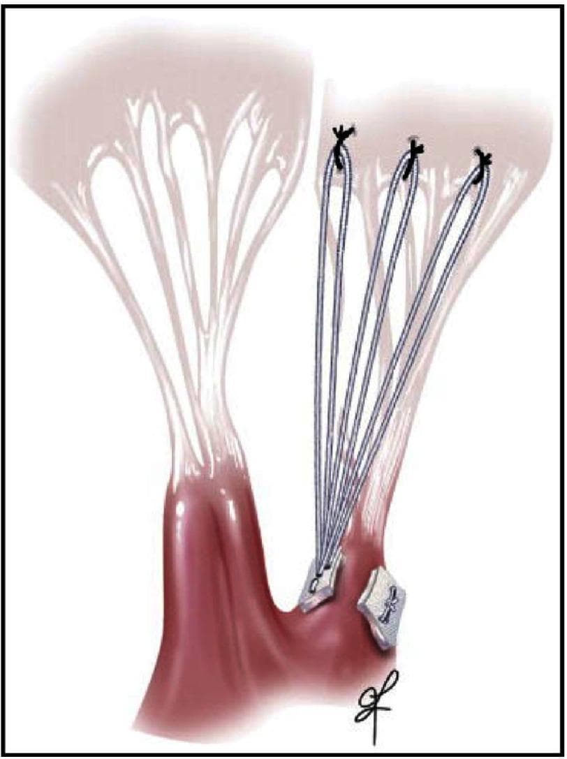 This medical illustration depicts a mitral valve repair utilizing artificial chordae tendineae (neochordae). The diagram shows a surgical view of the subvalvular apparatus, featuring the papillary muscles and mitral valve leaflets. Three sets of artificial chordal loops, represented as thin blue-grey lines made of PTFE, are anchored to the papillary muscle using white felt pledgets. The distal ends of these loops are sutured to the atrial aspect of the posterior mitral valve leaflet at the line of coaptation, visible as distinct black knots. Adjacent to the artificial cords, natural chordae tendineae are shown as thin, translucent string-like structures connecting the opposite leaflet to the papillary muscle. This illustration demonstrates a chordal replacement technique designed to treat mitral regurgitation—specifically for conditions like Barlow’s disease or fibroelastic deficiency—by restoring leaflet support and proper coaptation depth without the need for tissue resection.