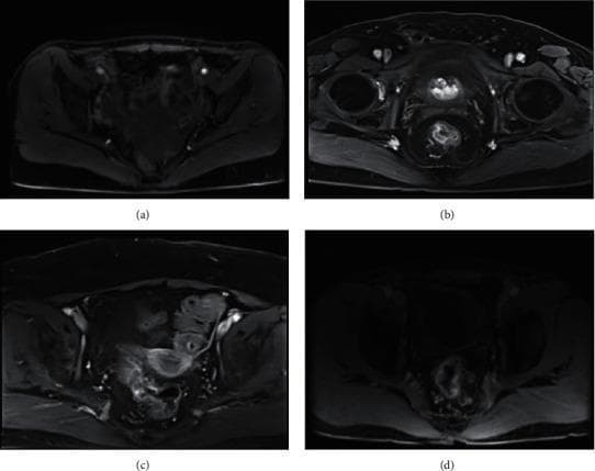 This diagnostic image set consists of four axial MRI scans (labeled a through d) demonstrating various TNM stages of rectal cancer (RC) in the pelvic region. Panel (a) shows stage T1 RC, characterized by a lesion with a high-signal submucosal layer intact and no visible involvement of the muscularis propria. Panel (b) illustrates stage T3 RC, where the tumor signal extends through the muscularis propria into the perirectal adipose tissue, though the mesorectal fascia appears clear. Panels (c) and (d) focus on nodal involvement (N staging); panel (c) shows stage N1 RC with a single hyperintense metastatic lymph node, while panel (d) demonstrates stage N2 RC with bilateral metastatic lymphadenopathy. The images utilize T2-weighted or diffusion-weighted characteristics to highlight variations in signal intensity between normal pelvic structures—such as the bladder, perirectal fat, and pelvic floor musculature—and malignant tissues. These scans serve as a comparison for assessing tumor depth (T-stage) and regional lymph node status (N-stage) in preoperative clinical staging.