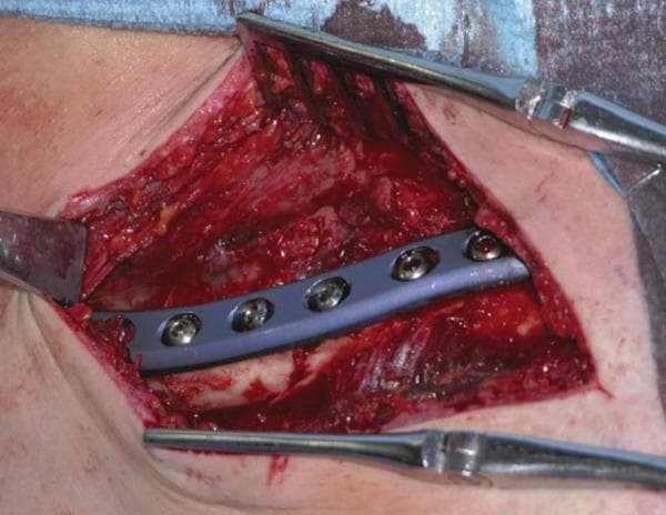A clinical photograph capturing an intraoperative view of an Open Reduction and Internal Fixation (ORIF) procedure for a displaced fracture of the middle third of the clavicle. The image shows a surgically exposed anatomical region with visible soft tissue dissection and presence of blood. A contoured, metallic, light-blue orthopedic compression plate is positioned across the fracture site to stabilize the bone fragments. The plate is secured with multiple metallic cortical screws, which are fully seated within the plate's pre-drilled holes. Self-retaining retractors and other surgical instruments are positioned at the margins of the incision to maintain visibility of the operative field. This visual illustrates standard orthopedic trauma management and the use of internal fixation hardware to promote primary bone healing in clavicular fractures.