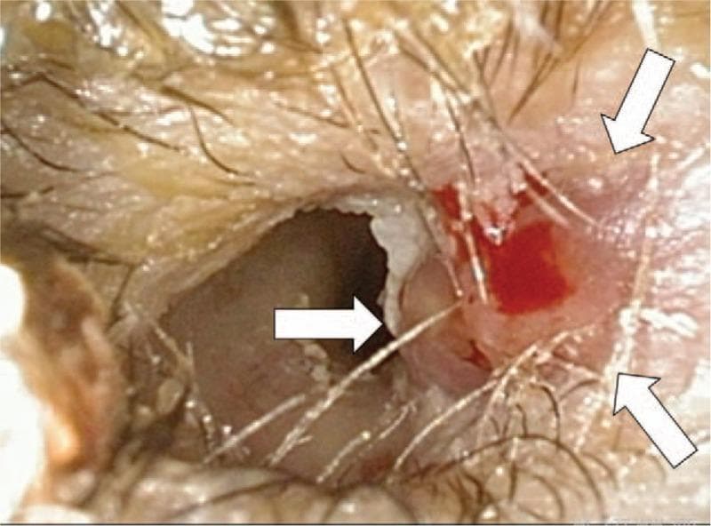 Clinical photograph of an otoscopic view showing the right external auditory canal. The image demonstrates significant pathological changes consistent with malignant external otitis. White arrows highlight the presence of friable, erythematous granulation tissue and focal ulceration on the floor and posterior wall of the canal. There is evidence of active inflammation with associated serosanguinous discharge and minor blood spotting. The canal lumen appears narrowed due to soft tissue edema. This visual evidence illustrates a hallmark clinical sign of skull base osteomyelitis (malignant otitis externa), particularly in the context of immunocompromised states such as diabetes mellitus or post-radiation therapy for head and neck squamous cell carcinoma. The surrounding skin of the meatus shows sparse hairs and mild maceration.
