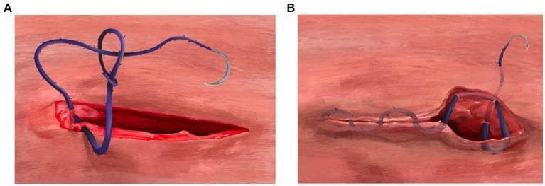 Two-part medical illustration demonstrating surgical closure techniques using a barbed suture. (A) depicts the initiation of a three-layer continuous closure at the rectus sheath level. A blue barbed suture with a curved needle is shown passing through both edges of a deep incision (approximately 5mm from the wound margin). The needle passes through a distal variable loop, illustrating a knotless anchoring mechanism to appose the body wall. (B) illustrates the termination of the subcuticular skin closure. The image shows the 'backwards stitch' and 'J-stitch' anchoring technique. To the right of the closed incision line, the suture is seen passing through a raised tissue segment in the opposite direction of the primary closure to provide friction-based security. The final segment of the suture exits the epidermis perpendicularly, allowing for knotless termination. This educational diagram is used to teach advanced suturing methods in surgical specialties, focusing on the mechanical advantages of barbed suture material for efficient wound management.