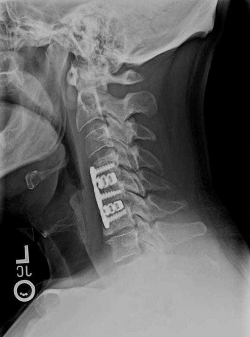 A diagnostic lateral X-ray of the cervical spine illustrating a post-surgical state at nine months follow-up. The image shows anterior cervical discectomy and fusion (ACDF) hardware in place, consisting of a rectangular metallic plate spanning the C4 to C6 vertebral bodies. The instrumentation is secured with four radiopaque screws, two inserted into the C4 vertebral body and two into the C6 vertebral body, providing stabilization across the C4-C5 and C5-C6 intervertebral spaces. The cervical spine demonstrates improved sagittal alignment with a preserved neutral to slightly lordotic curvature. The vertebral bodies exhibit sharp cortical margins and rectangular morphology, with visible resection of posterior osteophytes. There is evidence of early graft incorporation and stable intervertebral disc height within the fused segments. This imaging is clinically relevant for evaluating the success of spinal decompression and stabilization procedures in patients with radiculopathy or degenerative disc disease.